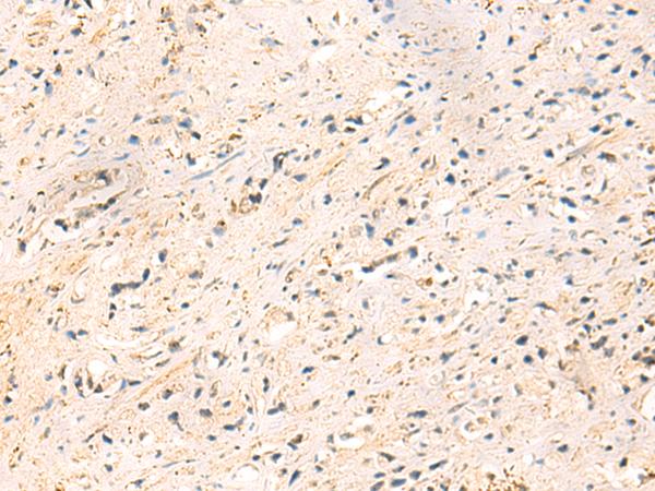 IP6K3 Antibody - Immunohistochemistry of paraffin-embedded Human prost at e cancer tissue  using IP6K3 Polyclonal Antibody at dilution of 1:50(×200)