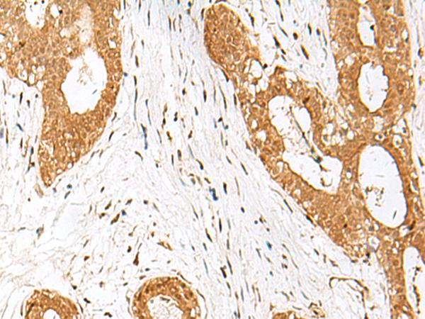 IPO11 / Importin 11 Antibody - Immunohistochemistry of paraffin-embedded Human breast cancer tissue  using IPO11 Polyclonal Antibody at dilution of 1:70(×200)