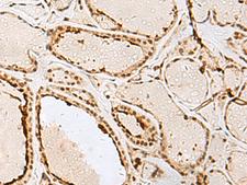IPO11 / Importin 11 Antibody - Immunohistochemistry of paraffin-embedded Human thyroid cancer tissue  using IPO11 Polyclonal Antibody at dilution of 1:65(×200)