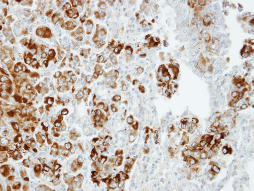 IPO13 / LGL2 Antibody - IHC of paraffin-embedded CL1-5 xenograft using Importin 13 antibody at 1:100 dilution.