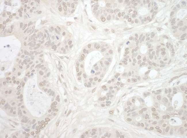 IPO4 Antibody - Detection of Human Importin 4 by Immunohistochemistry. Sample: FFPE section of human ovarian carcinoma. Antibody: Affinity purified rabbit anti-Importin 4 used at a dilution of 1:5000 (0.2 ug/mg).