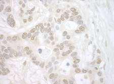 IPO4 Antibody - Detection of Human Importin 4 by Immunohistochemistry. Sample: FFPE section of human ovarian carcinoma. Antibody: Affinity purified rabbit anti-Importin 4 used at a dilution of 1:5000 (0.2 ug/mg).