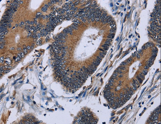 IPO4 Antibody - Immunohistochemistry of paraffin-embedded Human colon cancer using IPO4 Polyclonal Antibody at dilution of 1:50.