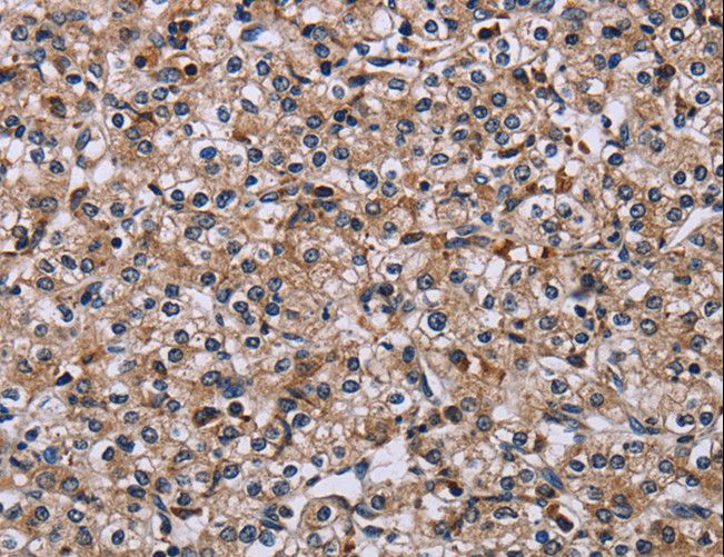 IPO4 Antibody - Immunohistochemistry of paraffin-embedded Human prostate cancer using IPO4 Polyclonal Antibody at dilution of 1:50.