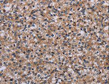 IPO4 Antibody - Immunohistochemistry of paraffin-embedded Human prostate cancer using IPO4 Polyclonal Antibody at dilution of 1:50.