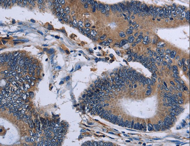 IPO4 Antibody - Immunohistochemistry of paraffin-embedded Human colon cancer using IPO4 Polyclonal Antibody at dilution of 1:50.