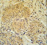 IPO7 / RANBP7 Antibody - IPO7 Antibody immunohistochemistry of formalin-fixed and paraffin-embedded human cervix carcinoma followed by peroxidase-conjugated secondary antibody and DAB staining.