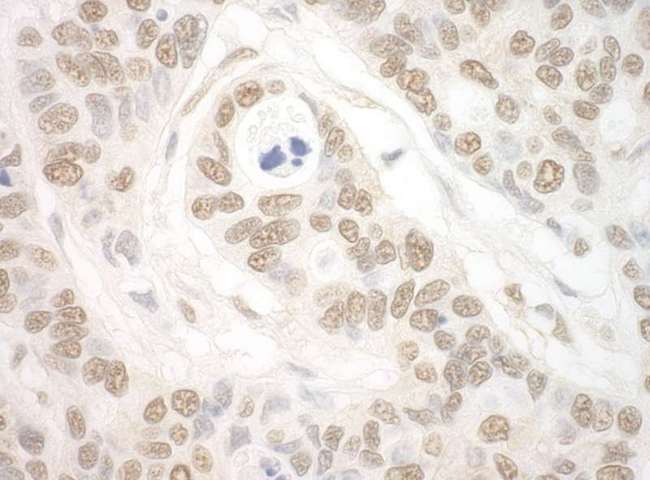 IPO7 / RANBP7 Antibody - Detection of Human Importin 7 by Immunohistochemistry. Sample: FFPE section of human ovarian carcinoma. Antibody: Affinity purified rabbit anti-Importin 7 used at a dilution of 1:1000 (0.2 ug/mg).