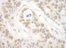 IPO7 / RANBP7 Antibody - Detection of Human Importin 7 by Immunohistochemistry. Sample: FFPE section of human ovarian carcinoma. Antibody: Affinity purified rabbit anti-Importin 7 used at a dilution of 1:1000 (0.2 ug/mg).