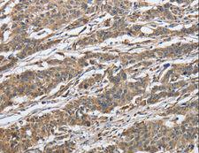 IPO7 / RANBP7 Antibody - Immunohistochemistry of paraffin-embedded Human gastric cancer using IPO7 Polyclonal Antibody at dilution of 1:40.