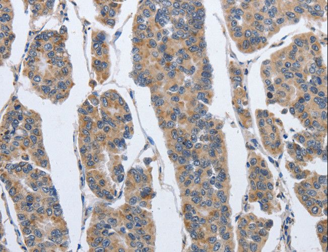 IPO7 / RANBP7 Antibody - Immunohistochemistry of paraffin-embedded Human breast cancer using IPO7 Polyclonal Antibody at dilution of 1:40.