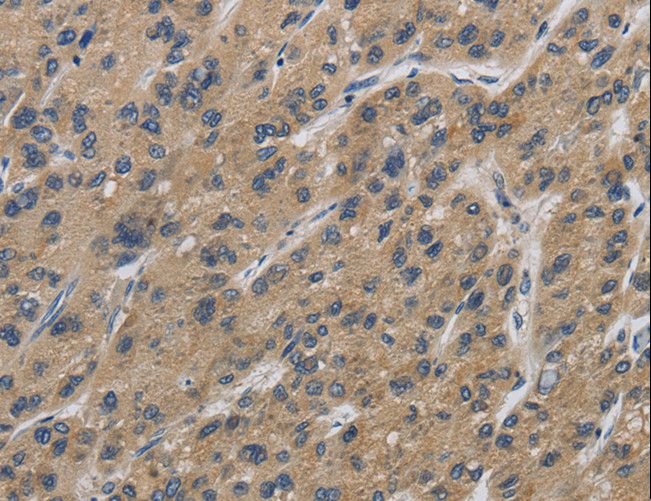 IPO7 / RANBP7 Antibody - Immunohistochemistry of paraffin-embedded Human liver cancer using IPO7 Polyclonal Antibody at dilution of 1:40.