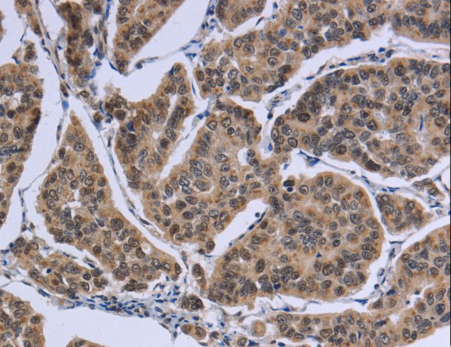 IPO8 / Importin 8 Antibody - Immunohistochemistry of paraffin-embedded Human gastric cancer using IPO8 Polyclonal Antibody at dilution of 1:50.