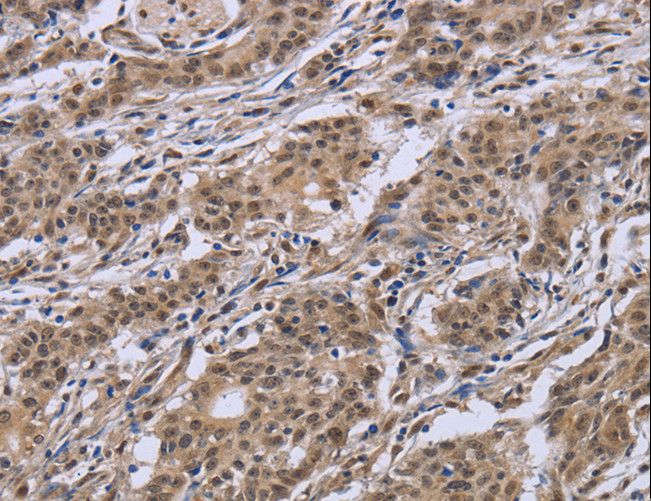 IPO8 / Importin 8 Antibody - Immunohistochemistry of paraffin-embedded Human gastric cancer using IPO8 Polyclonal Antibody at dilution of 1:50.