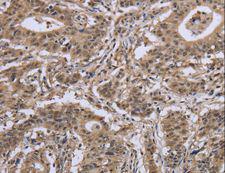IPO8 / Importin 8 Antibody - Immunohistochemistry of paraffin-embedded Human esophagus cancer using IPO8 Polyclonal Antibody at dilution of 1:50.