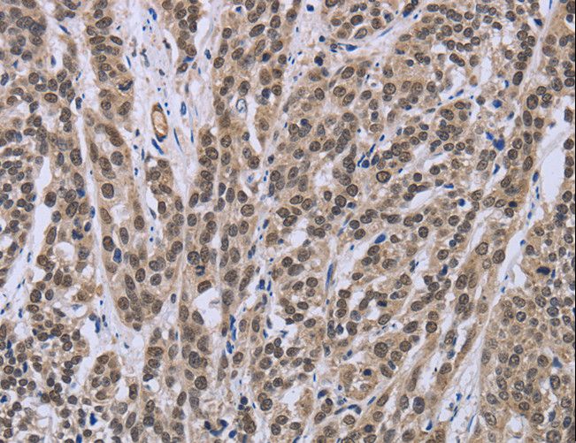 IPO8 / Importin 8 Antibody - Immunohistochemistry of paraffin-embedded Human esophagus cancer using IPO8 Polyclonal Antibody at dilution of 1:50.