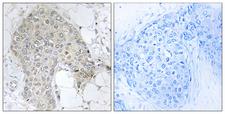 IPP2 / PPP1R2 Antibody - Peptide - + Immunohistochemistry analysis of paraffin-embedded human breast carcinoma tissue using PPP1R2 (Ab-120/121) antibody.