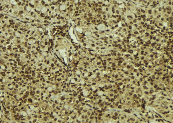 IPPK Antibody - 1:100 staining human breast carcinoma tissue by IHC-P. The sample was formaldehyde fixed and a heat mediated antigen retrieval step in citrate buffer was performed. The sample was then blocked and incubated with the antibody for 1.5 hours at 22°C. An HRP conjugated goat anti-rabbit antibody was used as the secondary.