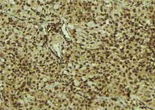 IPPK Antibody - 1:100 staining human breast carcinoma tissue by IHC-P. The sample was formaldehyde fixed and a heat mediated antigen retrieval step in citrate buffer was performed. The sample was then blocked and incubated with the antibody for 1.5 hours at 22°C. An HRP conjugated goat anti-rabbit antibody was used as the secondary.