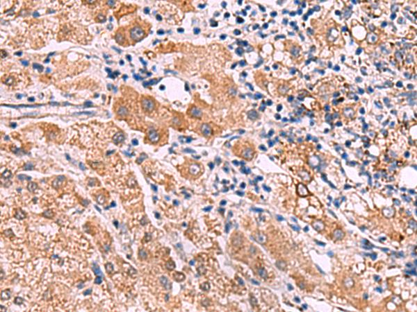 IPPK Antibody - Immunohistochemistry of paraffin-embedded Human liver cancer tissue  using IPPK Polyclonal Antibody at dilution of 1:30(×200)