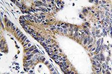 IQCB1 Antibody - IHC of Nephrocystin-5 (R467) pAb in paraffin-embedded human colon carcinoma tissue.