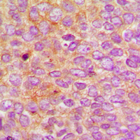 IQCB1 Antibody - Immunohistochemical analysis of Nephrocystin 5 staining in human breast cancer formalin fixed paraffin embedded tissue section. The section was pre-treated using heat mediated antigen retrieval with sodium citrate buffer (pH 6.0). The section was then incubated with the antibody at room temperature and detected using an HRP conjugated compact polymer system. DAB was used as the chromogen. The section was then counterstained with hematoxylin and mounted with DPX.
