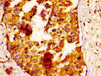 IQCB1 Antibody - Immunohistochemistry image at a dilution of 1:100 and staining in paraffin-embedded human breast cancer performed on a Leica BondTM system. After dewaxing and hydration, antigen retrieval was mediated by high pressure in a citrate buffer (pH 6.0) . Section was blocked with 10% normal goat serum 30min at RT. Then primary antibody (1% BSA) was incubated at 4 °C overnight. The primary is detected by a biotinylated secondary antibody and visualized using an HRP conjugated ABC system.