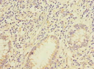 IQCC Antibody - Immunohistochemistry of paraffin-embedded human colon cancer using IQCC Antibody at dilution of 1:100