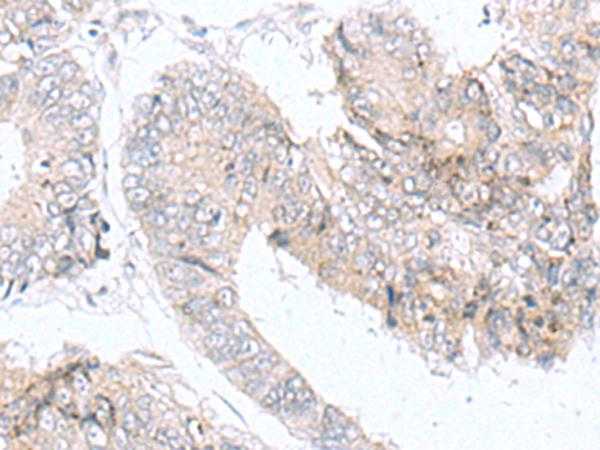 IQCD Antibody - Immunohistochemistry of paraffin-embedded Human colorectal cancer tissue  using IQCD Polyclonal Antibody at dilution of 1:90(×200)