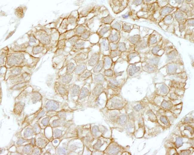 IQGAP1 Antibody - Detection of Human IQGAP1 by Immunohistochemistry. Sample: FFPE section of human breast carcinoma. Antibody: Affinity purified rabbit anti-IQGAP1 used at a dilution of 1:100.