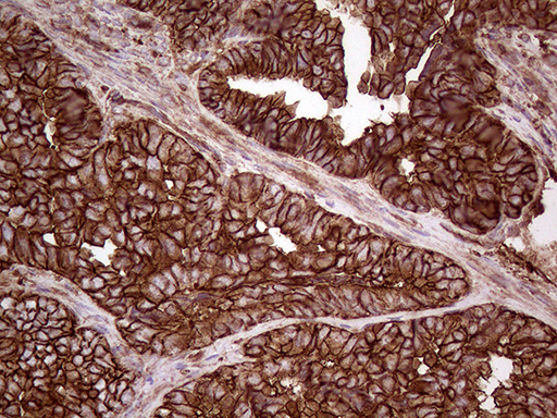 IQGAP1 Antibody - Immunohistochemical staining of paraffin-embedded Adenocarcinoma of Human endometrium tissue using anti-IQGAP1 mouse monoclonal antibody. (Heat-induced epitope retrieval by 1mM EDTA in 10mM Tris buffer. (pH8.5) at 120°C for 3 min. (1:5000)