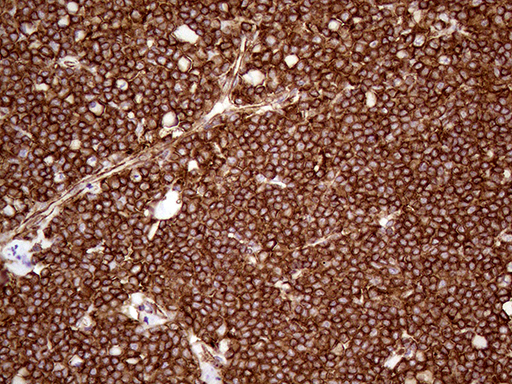 IQGAP1 Antibody - Immunohistochemical staining of paraffin-embedded Human lymphoma tissue using anti-IQGAP1 mouse monoclonal antibody. (Heat-induced epitope retrieval by 1mM EDTA in 10mM Tris buffer. (pH8.5) at 120°C for 3 min. (1:5000)