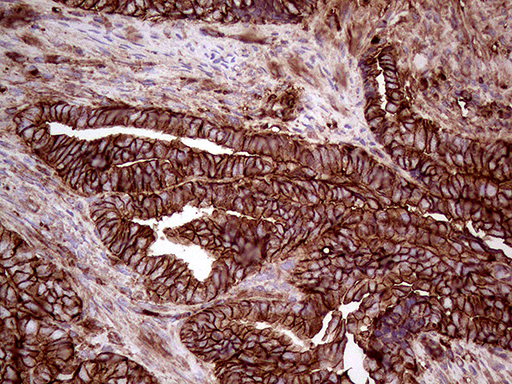 IQGAP1 Antibody - Immunohistochemical staining of paraffin-embedded Adenocarcinoma of Human endometrium tissue using anti-IQGAP1 mouse monoclonal antibody. (Heat-induced epitope retrieval by 1mM EDTA in 10mM Tris buffer. (pH8.5) at 120°C for 3 min. (1:5000)