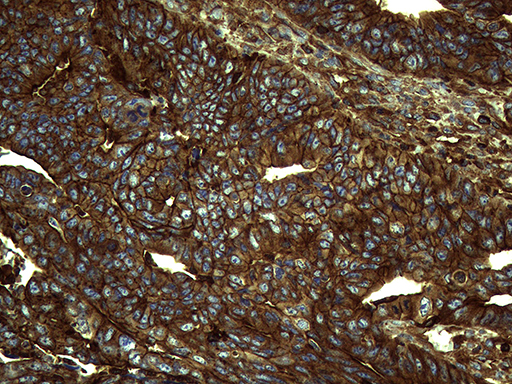 IQGAP1 Antibody - Immunohistochemical staining of paraffin-embedded Adenocarcinoma of Human colon tissue using anti-IQGAP1 mouse monoclonal antibody. (Heat-induced epitope retrieval by 1mM EDTA in 10mM Tris buffer. (pH8.5) at 120°C for 3 min. (1:2000)