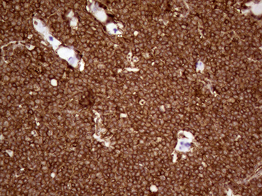 IQGAP1 Antibody - Immunohistochemical staining of paraffin-embedded Human lymphoma tissue using anti-IQGAP1 mouse monoclonal antibody. (Heat-induced epitope retrieval by 1mM EDTA in 10mM Tris buffer. (pH8.5) at 120°C for 3 min. (1:5000)