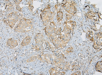 IQGAP1 Antibody - IHC staining of FFPE human breast cancer with IQGAP1 antibody at 1ug/ml. HIER: boil tissue sections in pH6, 10mM citrate buffer, for 10-20 min and allow to cool before testing.