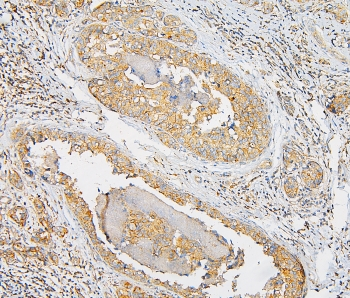 IQGAP1 Antibody - IHC staining of FFPE human breast cancer with IQGAP1 antibody at 1ug/ml. HIER: boil tissue sections in pH6, 10mM citrate buffer, for 10-20 min and allow to cool before testing.