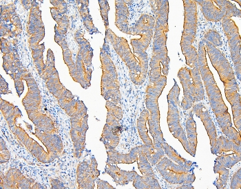 IQGAP1 Antibody - IHC staining of FFPE human intestinal cancer with IQGAP1 antibody at 1ug/ml. HIER: boil tissue sections in pH6, 10mM citrate buffer, for 10-20 min and allow to cool before testing.