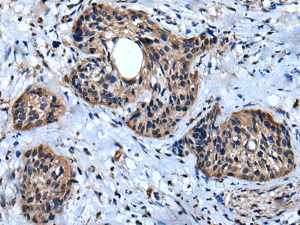 IQGAP1 Antibody - Immunohistochemistry of paraffin-embedded Human cervical cancer tissue  using IQGAP1 Polyclonal Antibody at dilution of 1:30(×200)