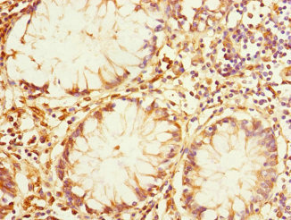 IQGAP3 Antibody - Immunohistochemistry of paraffin-embedded human colon cancer at dilution 1:100