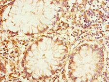 IQGAP3 Antibody - Immunohistochemistry of paraffin-embedded human colon cancer at dilution 1:100