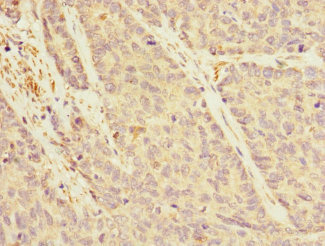 IQGAP3 Antibody - Immunohistochemistry of paraffin-embedded human ovarian cancer at dilution 1:100