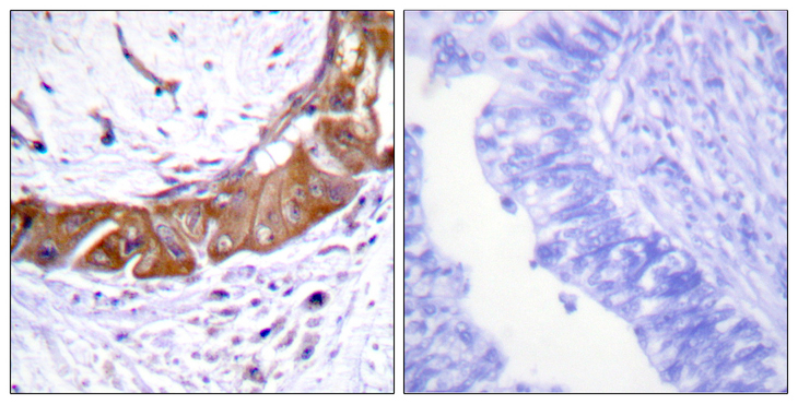 IRAK1 / IRAK Antibody - Immunohistochemistry analysis of paraffin-embedded human colon carcinoma, using IRAK1 (Phospho-Thr100) Antibody. The picture on the right is blocked with the phospho peptide.