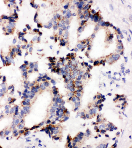 IRAK2 / IRAK-2 Antibody - IRAK2 / IRAK-2 antibody. IHC(P): Human Lung Cancer Tissue.