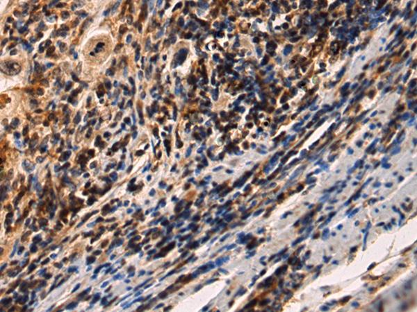 IRAK2 / IRAK-2 Antibody - Immunohistochemistry of paraffin-embedded Human esophagus cancer tissue  using IRAK2 Polyclonal Antibody at dilution of 1:60(×200)