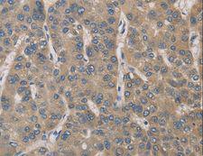 IRAK4 / IRAK-4 Antibody - Immunohistochemistry of paraffin-embedded Human gastric cancer using IRAK4 Polyclonal Antibody at dilution of 1:40.