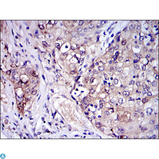 IRAK4 / IRAK-4 Antibody - Immunohistochemistry (IHC) analysis of paraffin-embedded human lung cancer Tissues with DAB staining using IRAK-4 Monoclonal Antibody.