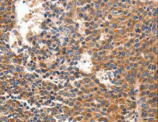 IRF1 / MAR Antibody - Immunohistochemistry of paraffin-embedded Human liver cancer using IRF1 Polyclonal Antibody at dilution of 1:40.
