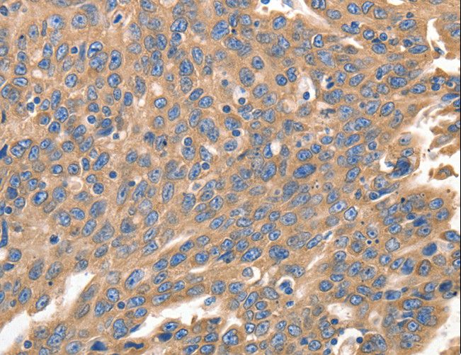 IRF1 / MAR Antibody - Immunohistochemistry of paraffin-embedded Human ovarian cancer using IRF1 Polyclonal Antibody at dilution of 1:40.