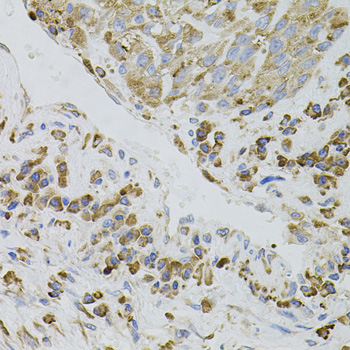 IRF1 / MAR Antibody - Immunohistochemistry of paraffin-embedded human lung cancer tissue.